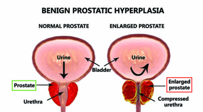 Benign prostatic hyperplasia, 3D illustration showing normal and enlarged prostate gland